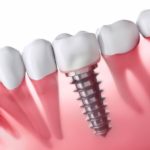 dental implant cost in dubai