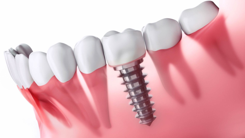 dental implant cost in dubai